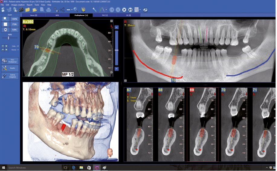 X-Radius Compact implant planlama ekranı