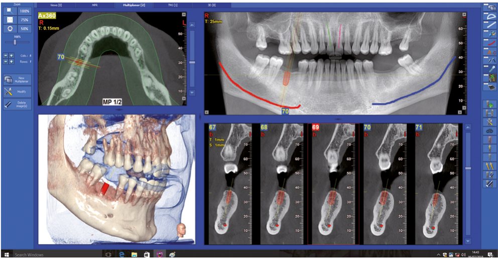 X-Radius Trio Plus 3D implant planlama ekranı