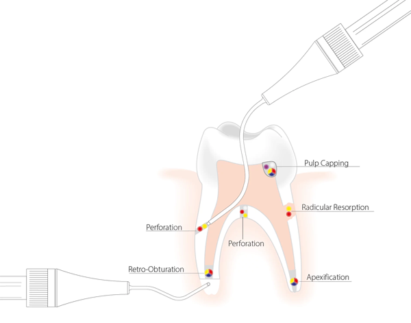 MAP System NiTi ve Surgery iğneleri