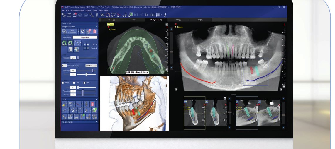 iRYS yazılımında implant planlama ekranı