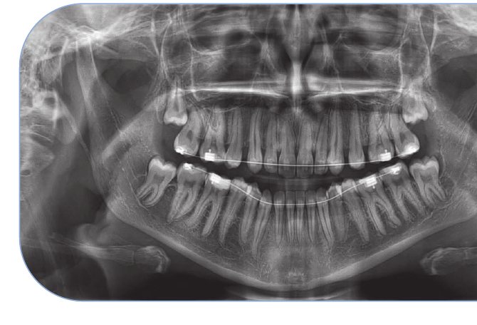 Super PAN ile tüm anatomik alanı netlikte gösteren panoramik görüntü